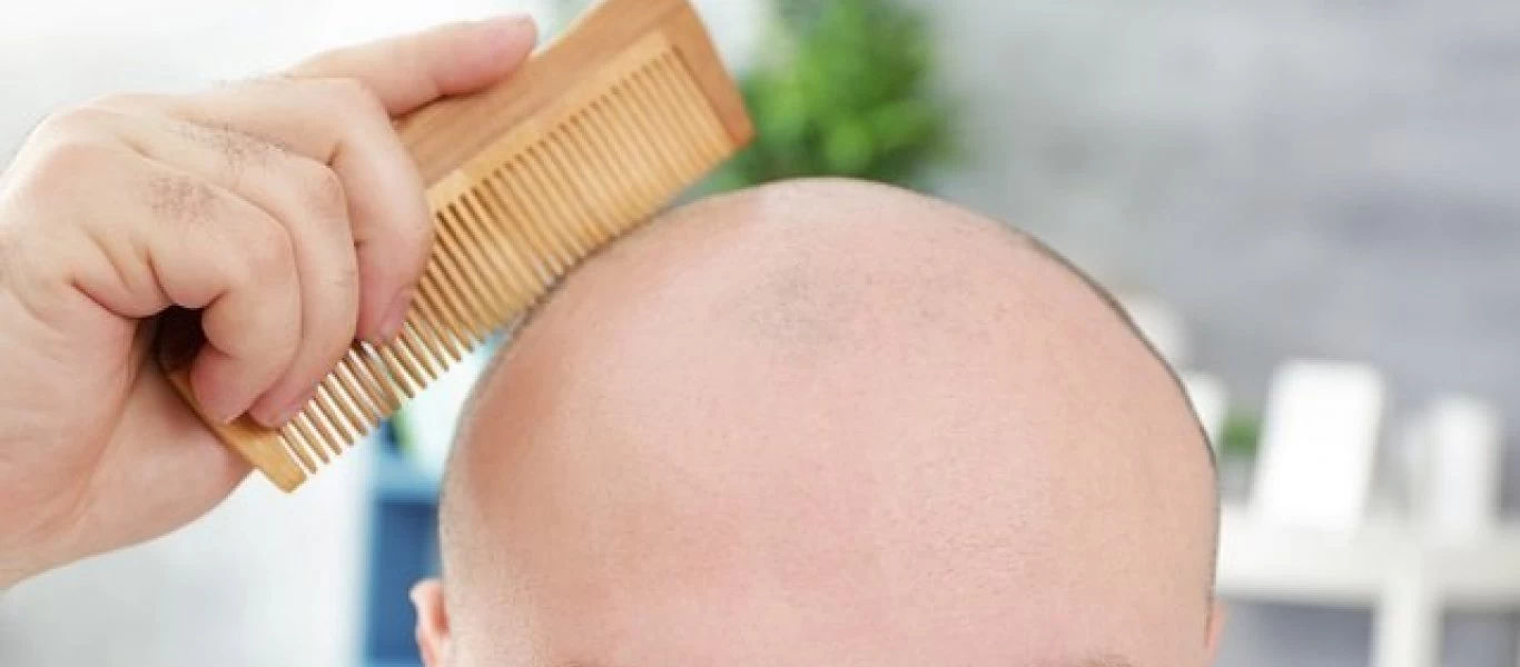 Πού οφείλεται η φαλάκρα και πώς μπορείτε να την καθυστερήσετε